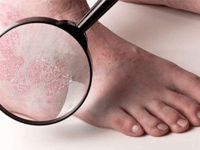 Сухість шкіри