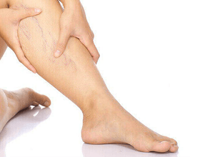 Варикозне розширення вен: