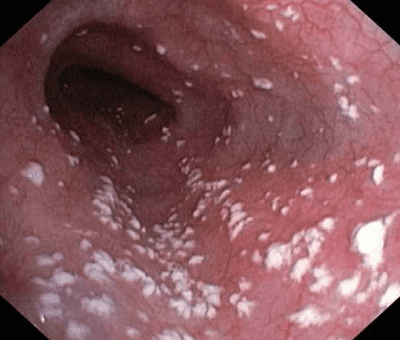 Кандидоз кишківника