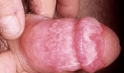 Молочниця у чоловіків на інтимному місці