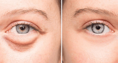 likyvannya-nabryakiv-pid-ochyma