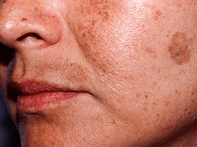 vikovi-pigmentni-plyamy