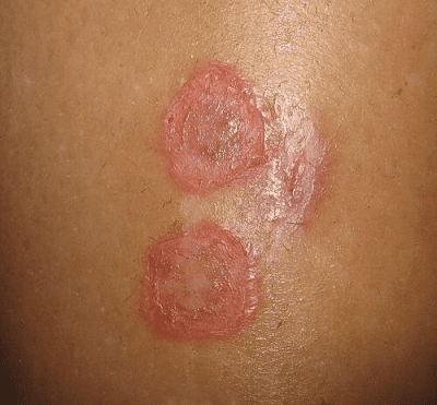 symptomy-streptodermiyi