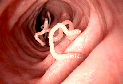 parazyty-glysty-symptomy-oznaky-likuvannya.