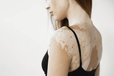 yak-vynykaye-vitiligo