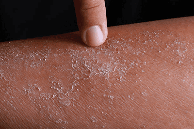 psoriaz-pershi-symptomy-i-podalshyj-rozvytok.