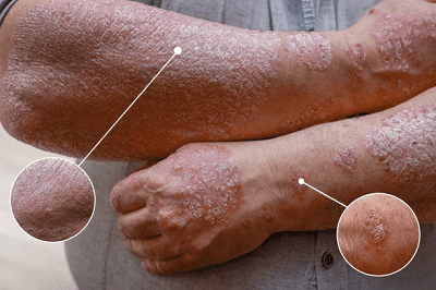 psoriaz-shho-cze-take-i-yak-proyavlyayetsya