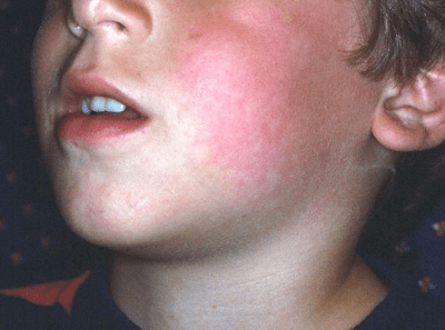 yaki-symptomy-sposterigayutsya-u-pacziyentiv-z-infekczijnoyu-erytemoyu