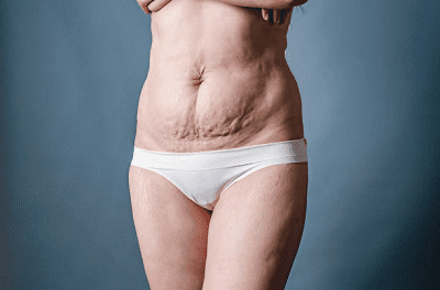 profilaktyka-ta-likuvannya-roztyazhok